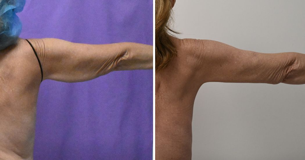 P2-20003 | Before and After Brachioplasty 6