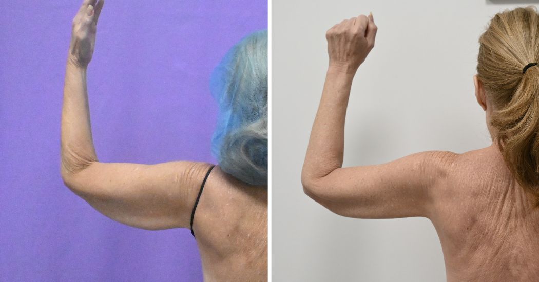 P2-20003 | Before and After Brachioplasty 7
