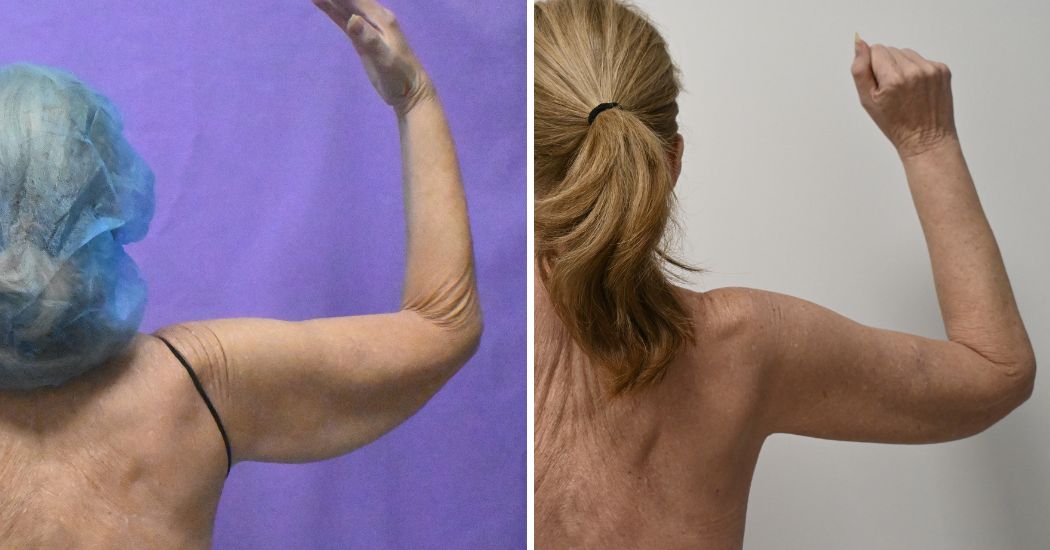 P2-20003 | Before and After Brachioplasty 8