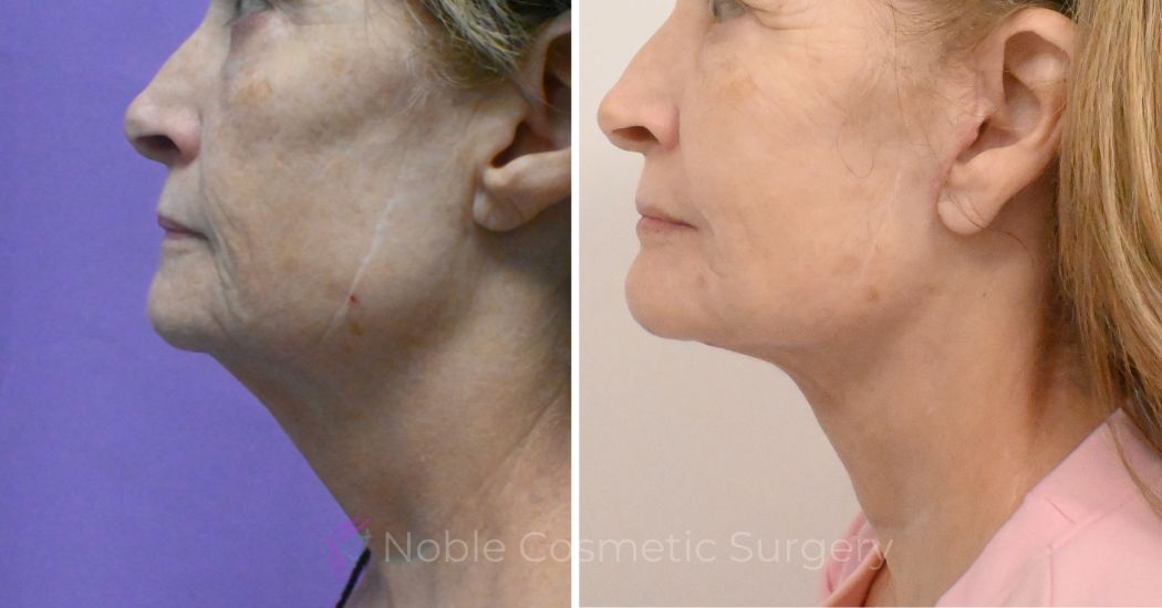 P2 Facelift and neck lift