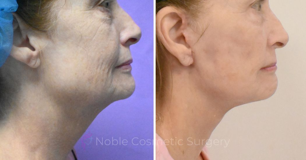 P2-F20003 | Before and After Facelift 2