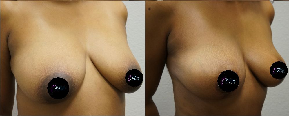 P3-00675 | Before and After Breast Reduction 2