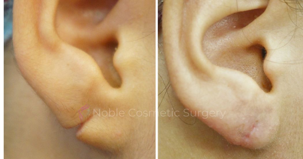 P3-00802E | Before and After Earlobe Repair
