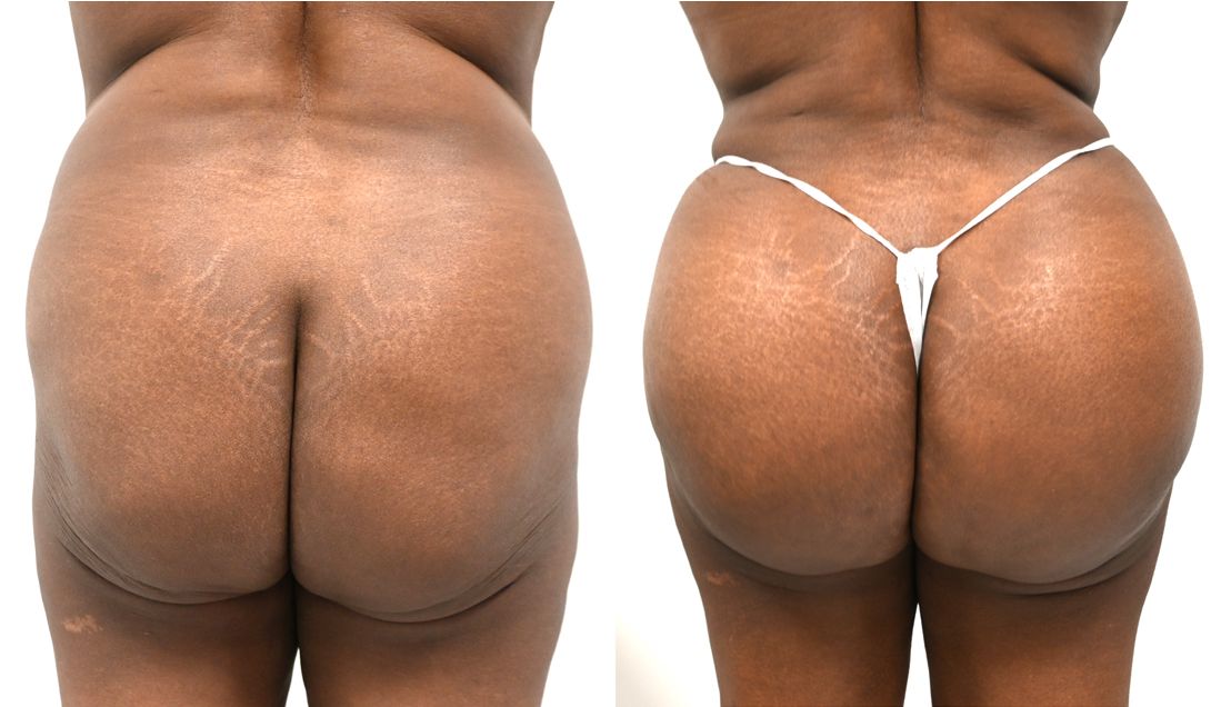 P3-00902-BBL | Before and After Brazilian Butt Lift