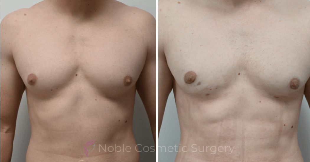 P3-17230 | Before and After Gynecomastia