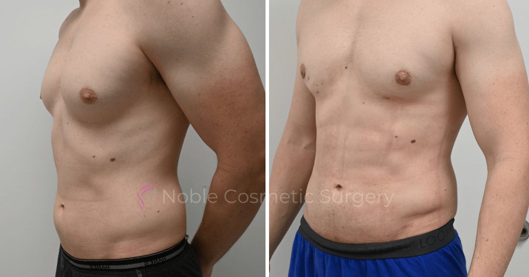 P3-17230 | Before and After Gynecomastia 2