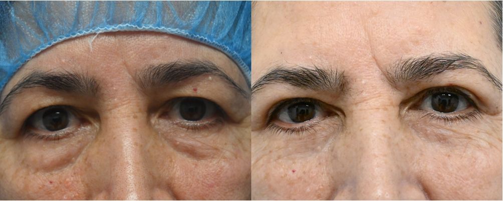 P3-19865 | Before and After Blepharoplasty