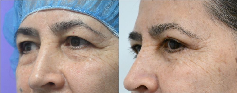 P3-19865 | Before and After Blepharoplasty 2
