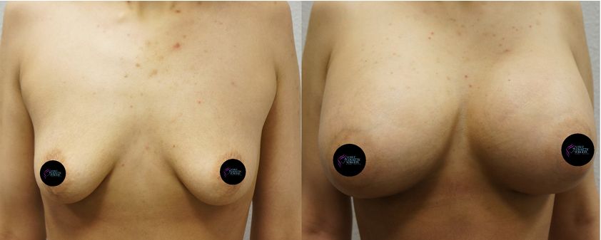 P4-00056 | Before and After Breast Augmentation