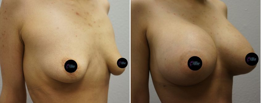 P4-00056 | Before and After Breast Augmentation 2