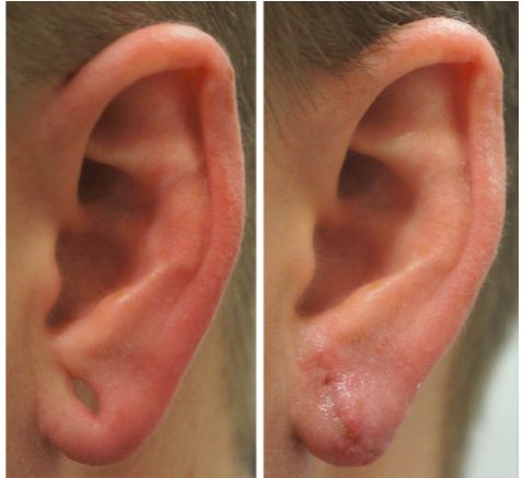 P4 earlobe repair