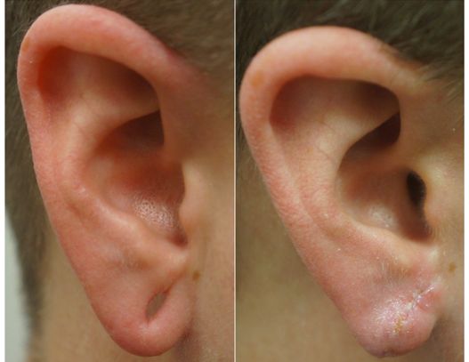 P4-00803E | Before and After Earlobe Repair