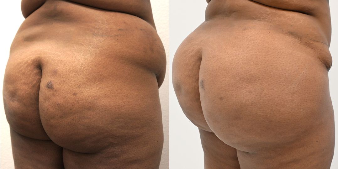 P4-00903-BBL | Before and After Brazilian Butt Lift