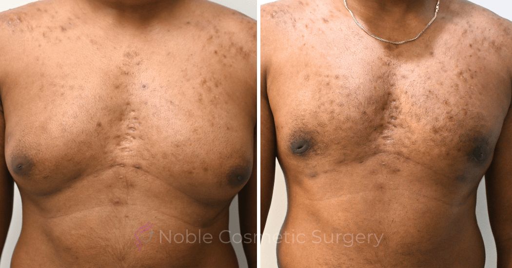 P4 Gynecomastia