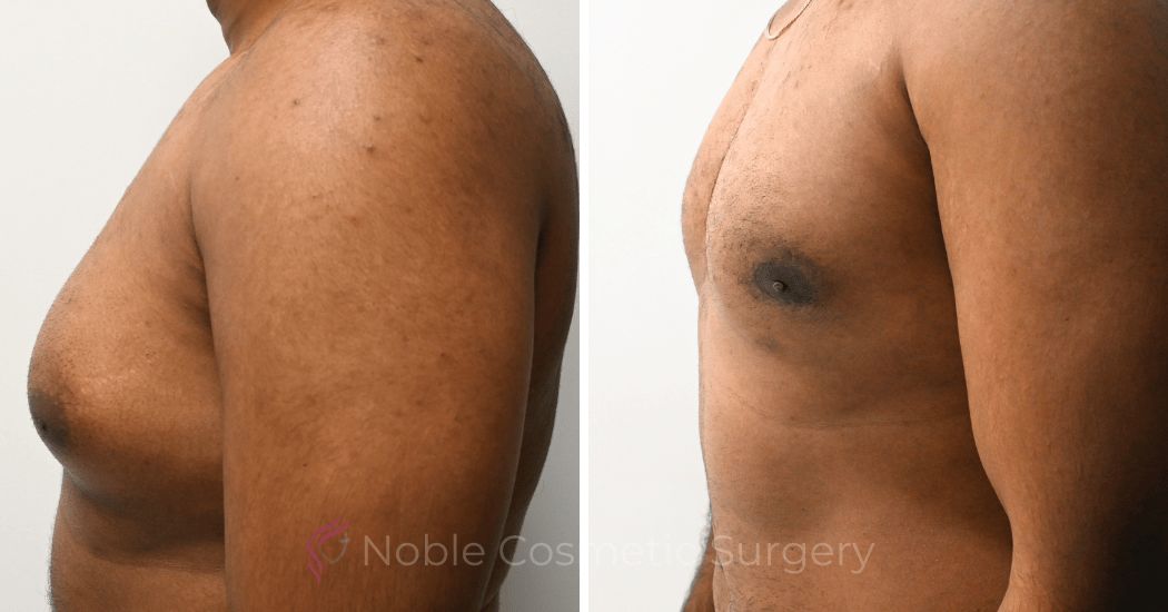 P4-10891 | Before and After Gynecomastia 2