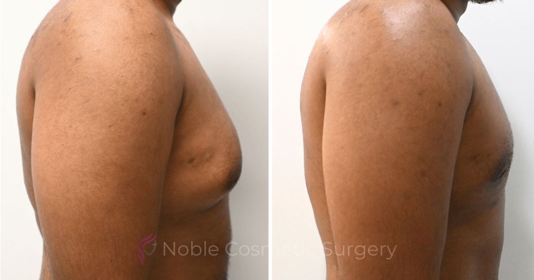 P4-10891 | Before and After Gynecomastia 3