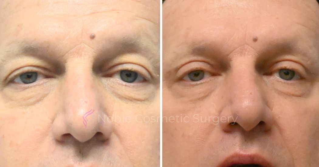 P4-19638 | Before and After Blepharoplasty