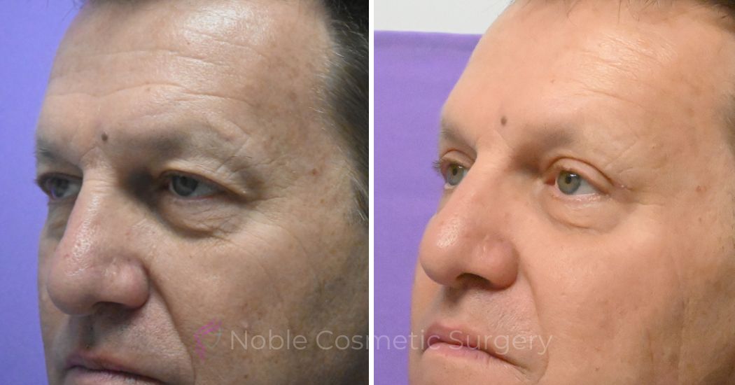 P4-19638 | Before and After Blepharoplasty 3