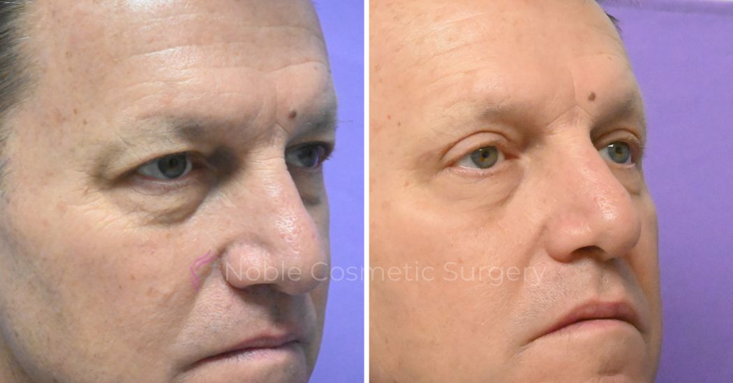 P4-19638 | Before and After Blepharoplasty 2