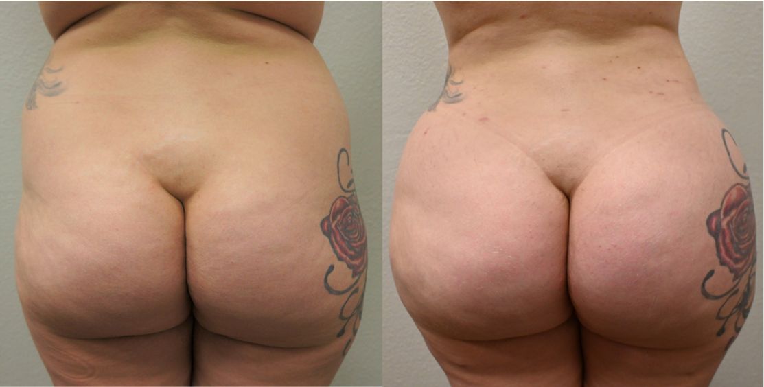 P5-00904-BBL | Before and After Brazilian Butt Lift