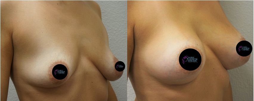 P5-16936 | Before and After Breast Augmentation 2