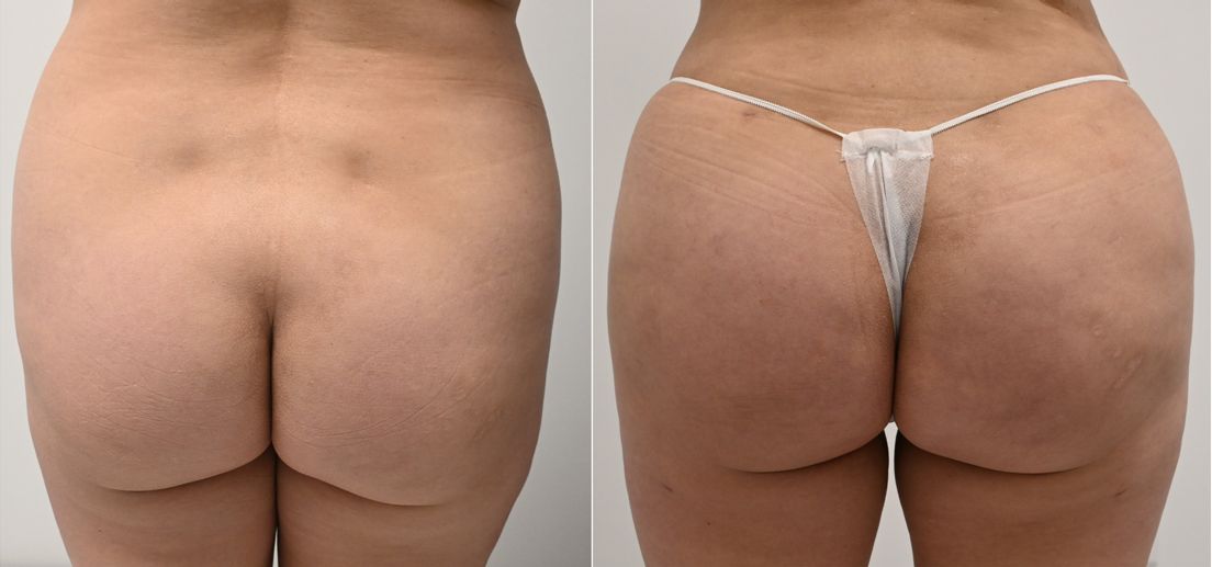 P6-00905-BBL | Before and After Brazilian Butt Lift