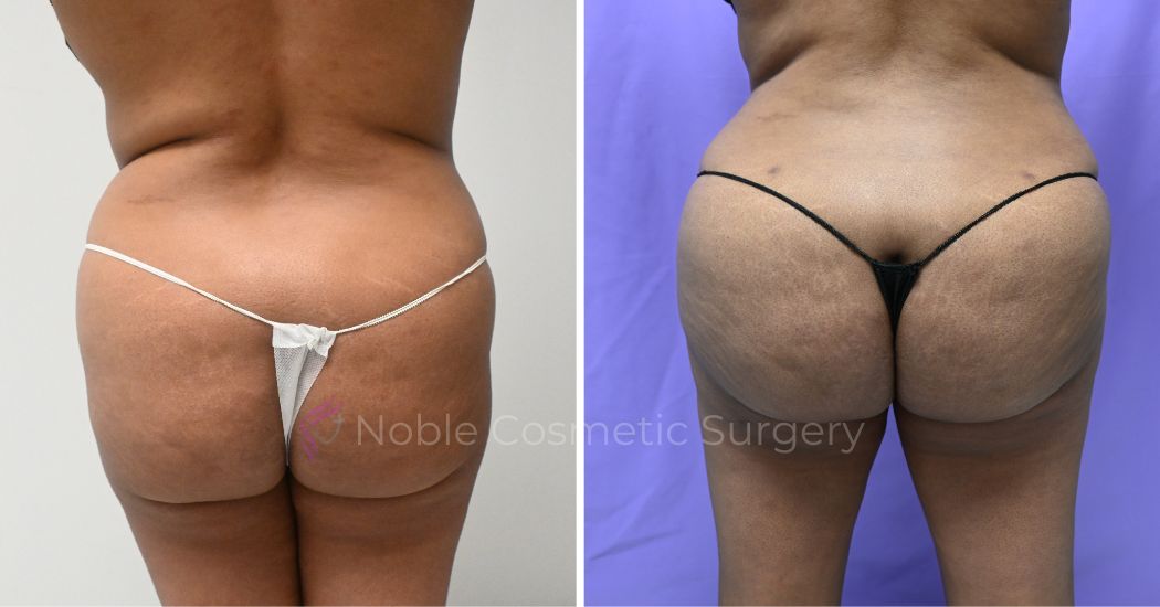 P7-00906-BBL | Before and After Brazilian Butt Lift