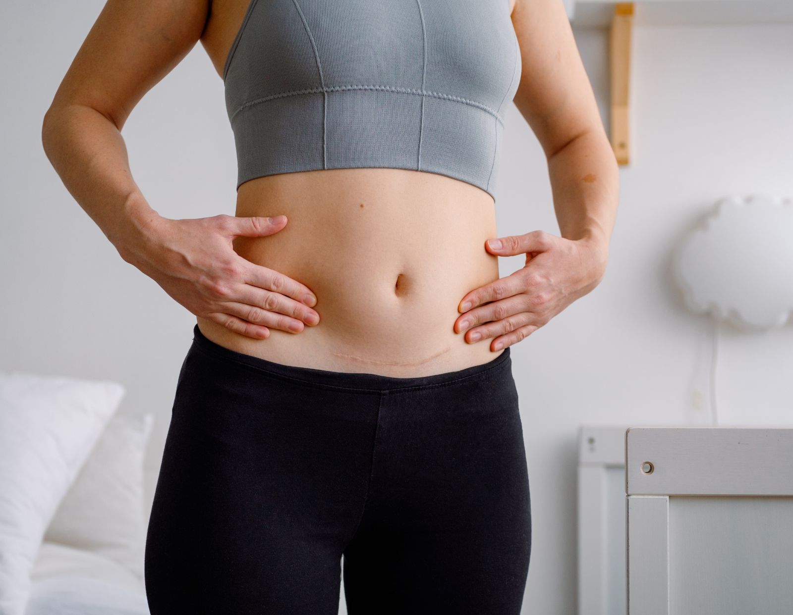 Woman pointing to the scar on her lower abdomen