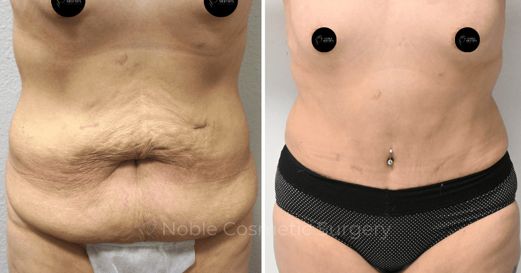 TUMMY-TUCK-CASE-00315 | Before and After Abdominoplasty 1