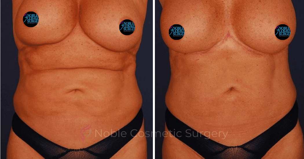 TUMMY-TUCK-CASE-00400 | Before and After Abdominoplasty 1