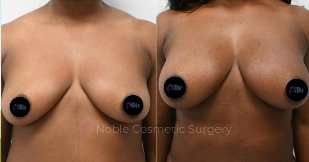 BREAST-AUGMENTATION--WITH-FAT-TRANSFER--CASE-10946 | Before and After Breast Augmentation