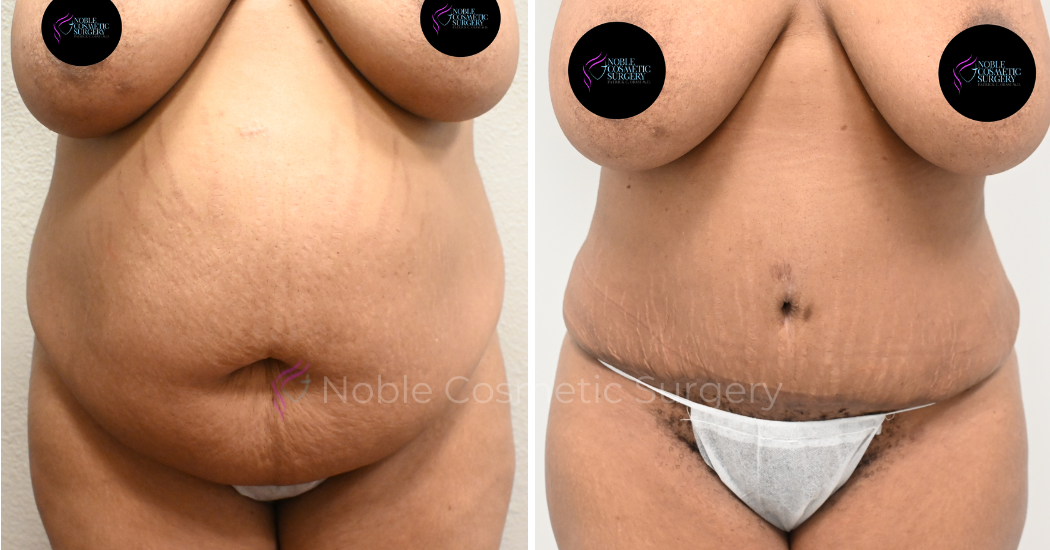 TUMMY-TUCK-CASE-00035 | Before and After Abdominoplasty 1