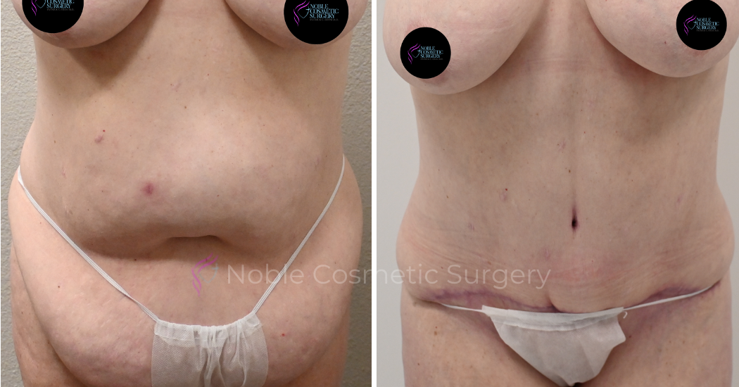 TUMMY-TUCK-CASE-00039 | Before and After Abdominoplasty 1