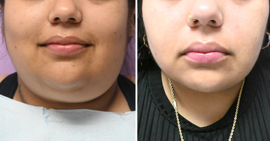 Case--10492 | Before and After Chin Liposuction