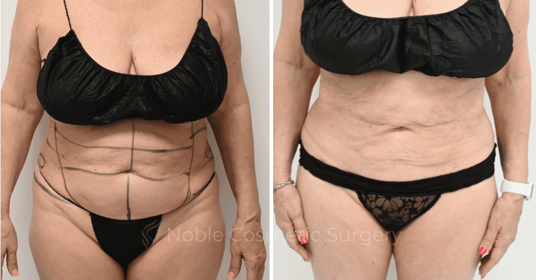 LIPOSUCTION-CASE-10145 | Before and After Liposuction