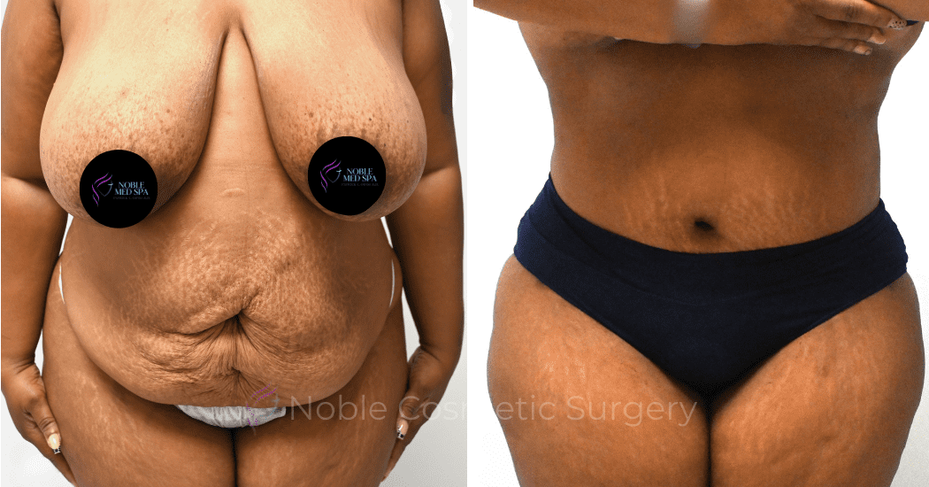 TUMMY-TUCK-CASE-14522 | Before and After Abdominoplasty