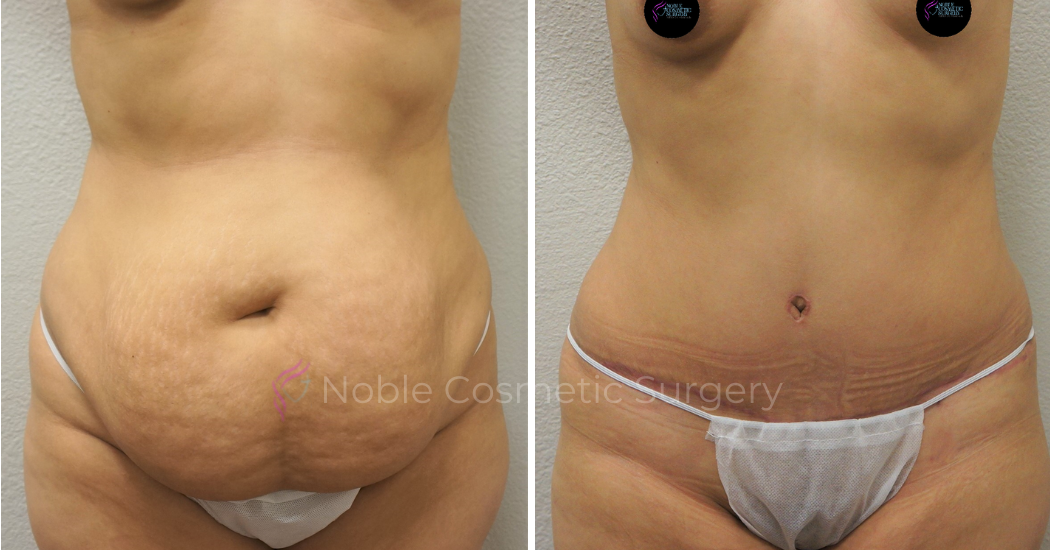 TUMMY-TUCK-CASE-00048 | Before and After Abdominoplasty 1