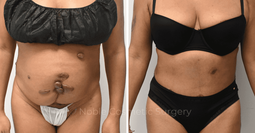 TUMMY-TUCK-CASE-10972 | Before and After Abdominoplasty