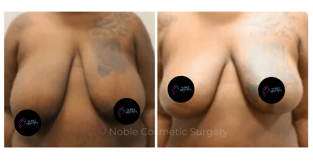 BREAST-REDUCTION-CASE-18364 | Before and After Breast Reduction