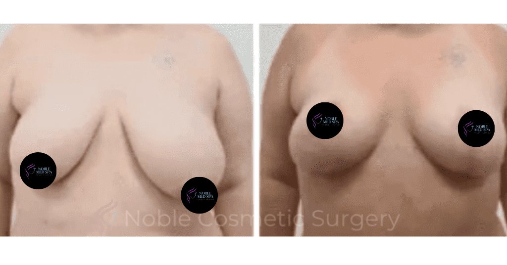 BREAST-REDUCTION-CASE-19223 | Before and After Breast Reduction