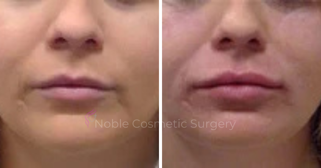 DERMAL-FILLERS-CASE-00258 | Before and After Dermal Fillers