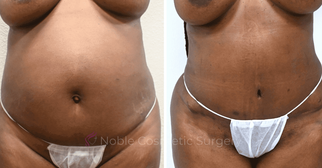 TUMMY-TUCK-CASE-13477 | Before and After Abdominoplasty