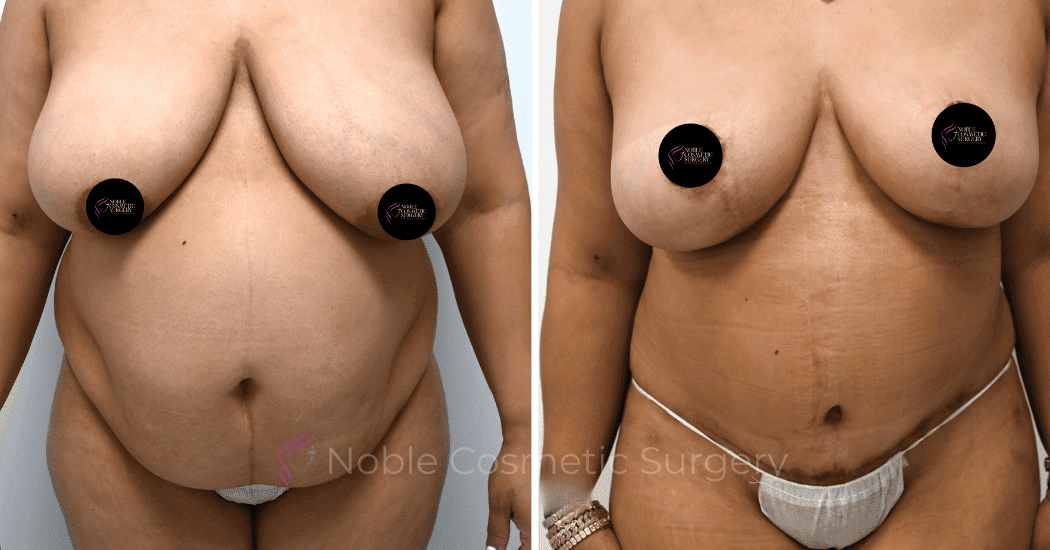 MOMMY-MAKEOVER-CASE-11303 | Before and After Mommy Makeover