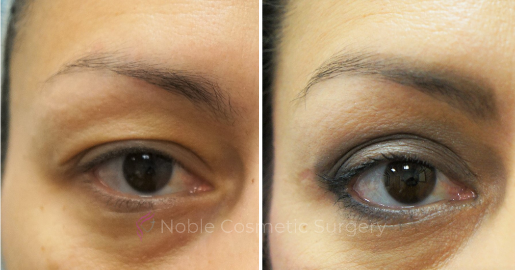 BLEPHAROPLASTY-CASE-16936 | Before and After Blepharoplasty 2