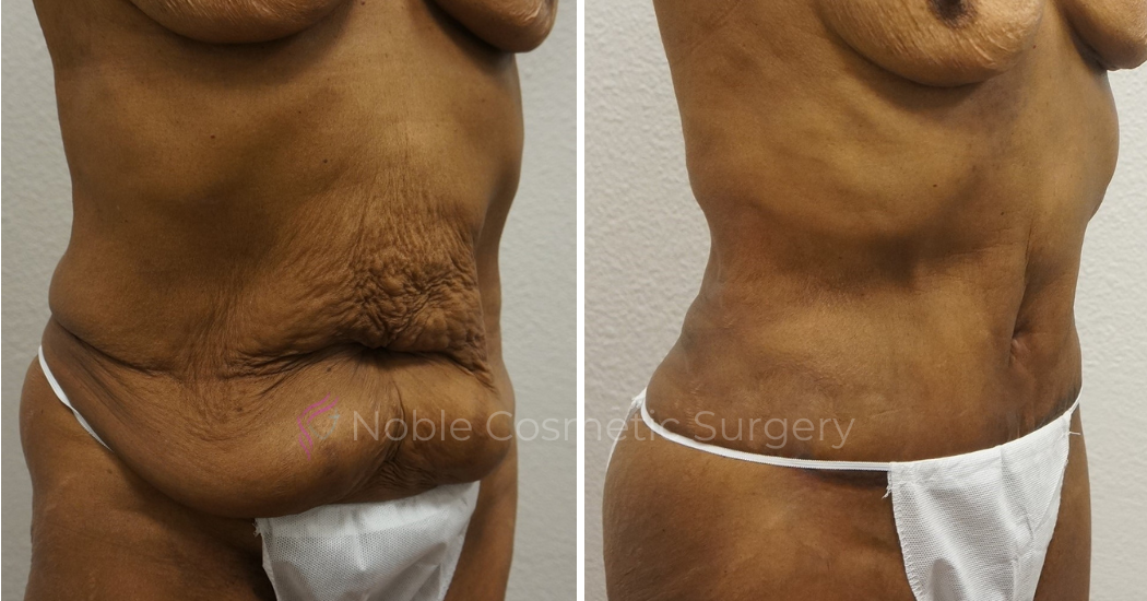 TUMMY-TUCK-CASE-00050 | Before and After Abdominoplasty 1