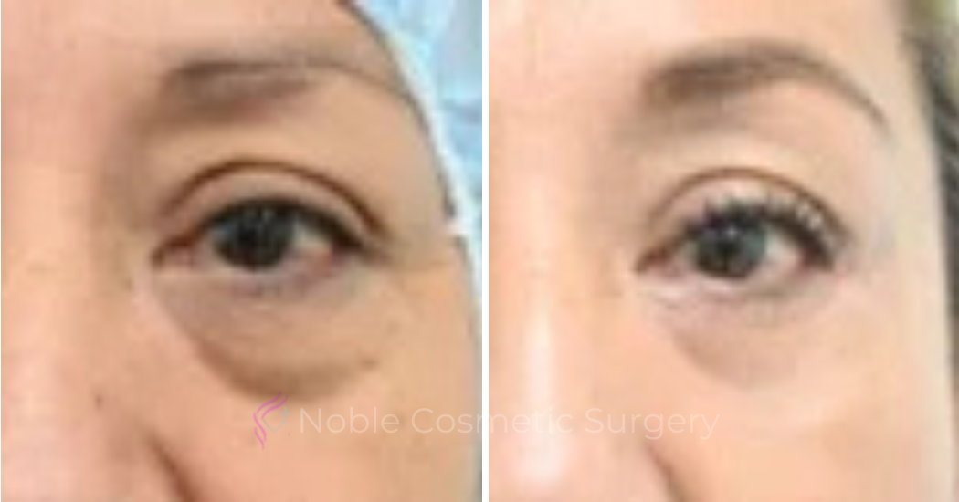 BLEPHAROPLASTY-CASE-00254 | Before and After Blepharoplasty