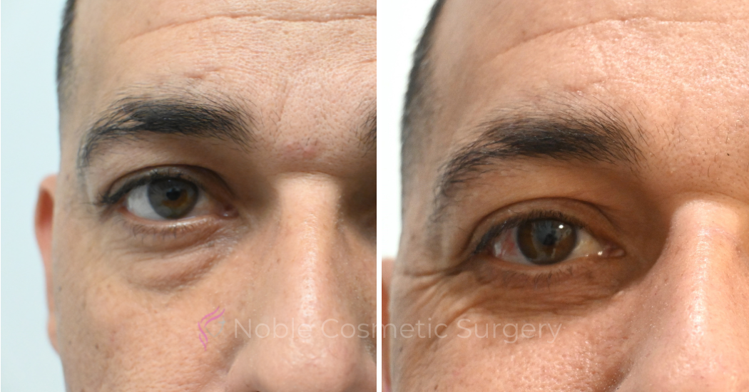 BLEPHAROPLASTY-CASE-10655 | Before and After Blepharoplasty 2