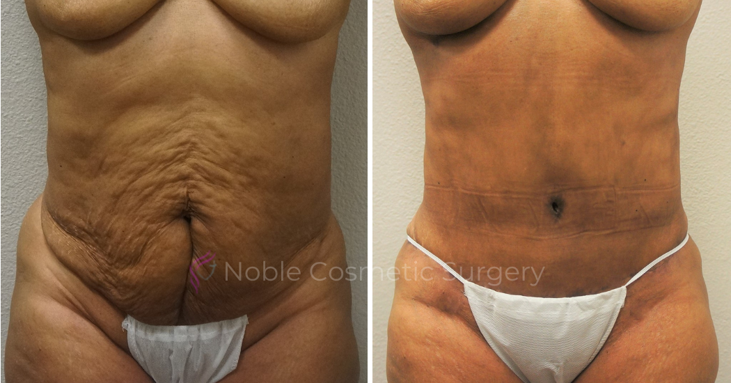 TUMMY-TUCK-CASE-00052 | Before and After Abdominoplasty 1