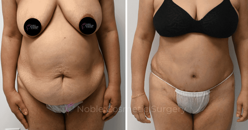 TUMMY-TUCK-CASE-11285 | Before and After Abdominoplasty
