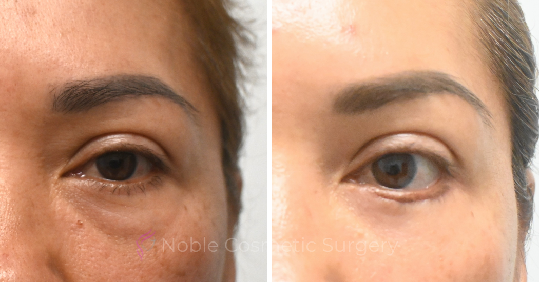 BLEPHAROPLASTY-CASE-19072 | Before and After Blepharoplasty